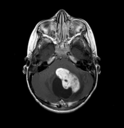 Juvenile Pilocytic Astrocytoma in the brainstem. Note the dark round image which is a fluid-filled structure