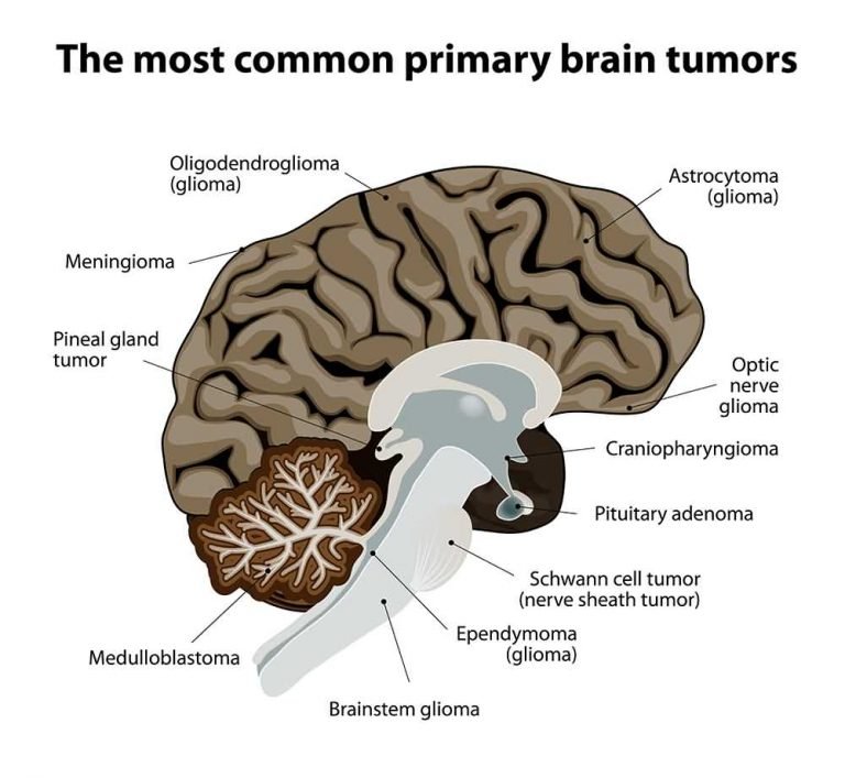 13 Types of Brain Tumors [SCIENTIFIC IMAGES] Left Side Pains