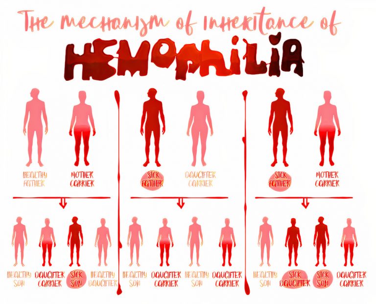 Hemophilia All You Need to Know About Hemophilia Page 9 of 16