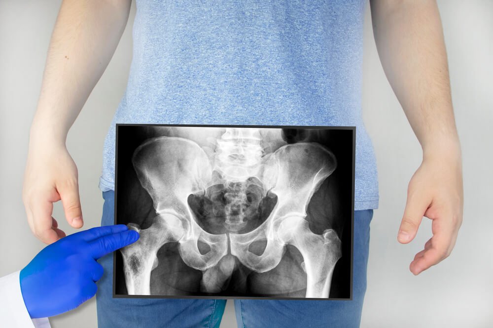 Hip Replacement (RA) | All You Need to Know About Hip Replacement ...